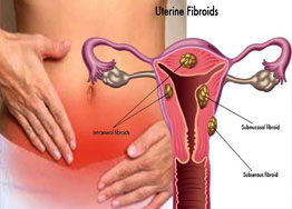 Fibroids Treatment doctor in rohini